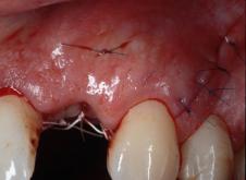 Microcirugía periodontal